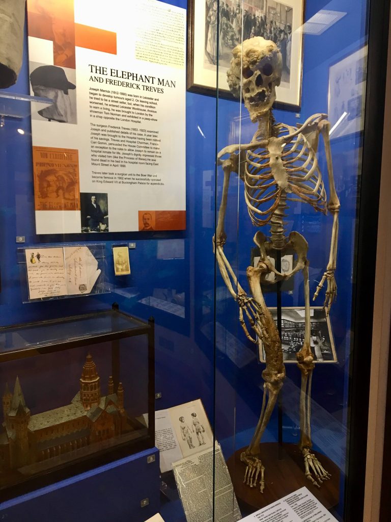 Replica skeleton of Joseph Merrick, The Elephant Man