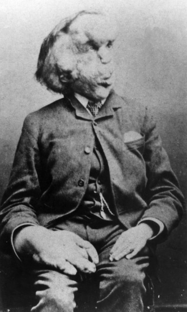 Joseph Merrick c.1889 © Royal London Hospital Archives