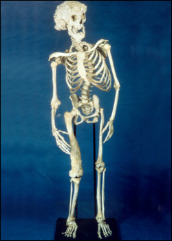 The skeleton of Joseph Merrick, the "Elephant Man", as kept in the collection of the Royal London Hospital.